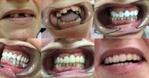 Antes y después de algunos tratamientos dentales