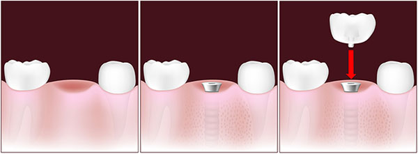 implante-un-diente-solo