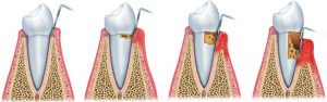 periodontitis-clinica