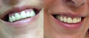 Reemplazo de coronas dentales-Arteixo