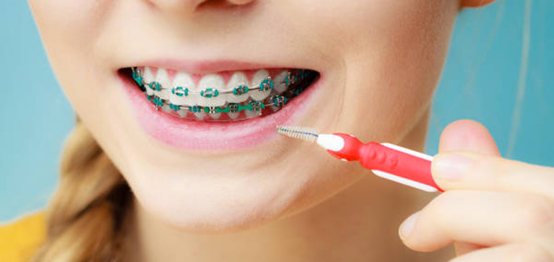 Higiene dental con Ortodoncia Fija